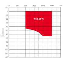 人工中耳VSB