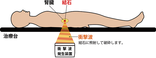 体外式衝撃波結石破砕術イメージ