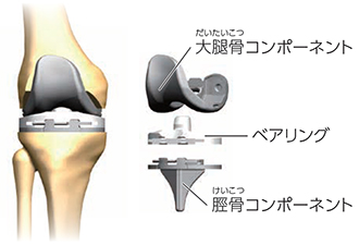人工膝関節全置換術（TKA）